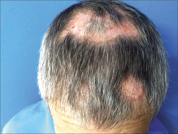 Clinical improvement of the lesions after 1 month of treatment