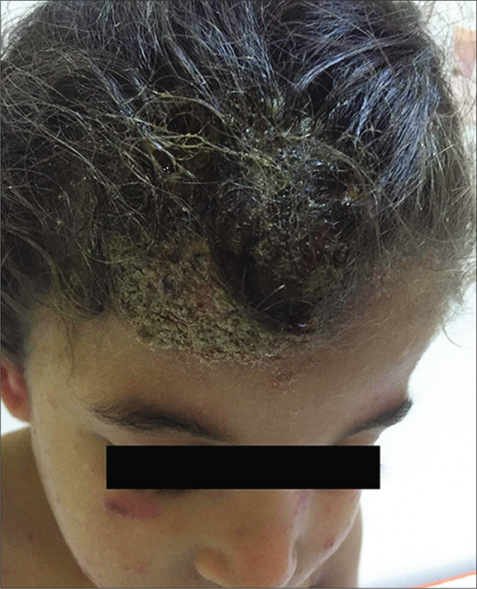 Inflammatory and crusted, matted mass on the scalp (kerion)