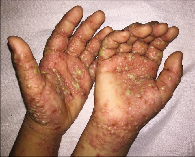 Multiple, large, non-follicular pustules on the palms