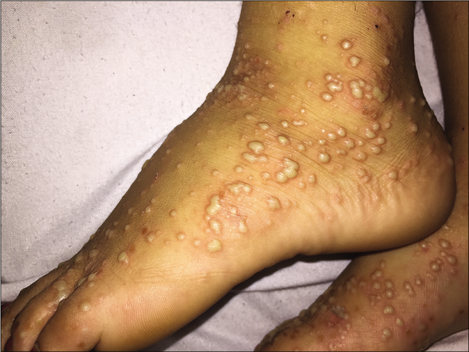 Pustules on the soles