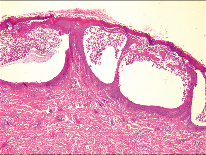 Subcorneal pustule containing neutrophils (H and E, ×40)