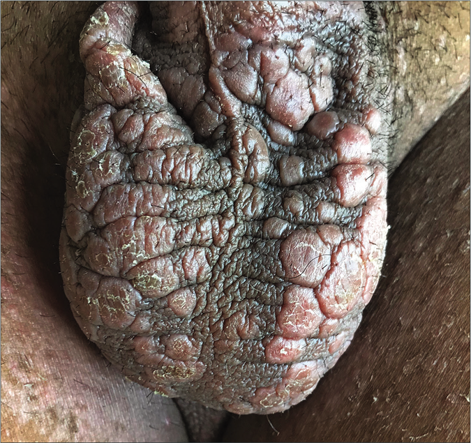 Multiple erythematous, flat-topped, round to oval plaques over the scrotum