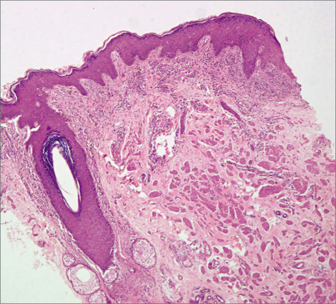 Histopathology shows acanthosis along with perivascular chronic mononuclear inflammatory cells. (H&E, 4×)