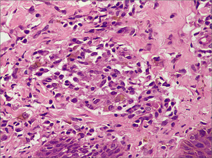 Higher magnification shows loose collection of histiocytes admixed with plasma cells in the dermis (H&E, 40×)