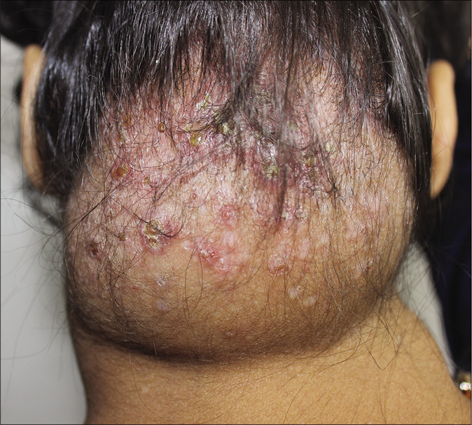 Soft swelling on nape of neck studded with erythematous papules, many of them covered with yellowish crust