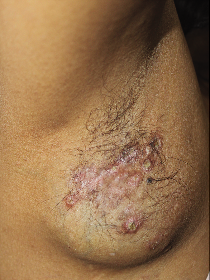 Swelling on right axilla studded with erythematous papules covered with yellowish crust