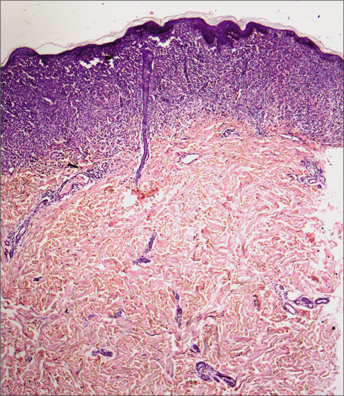 Upper and mid dermal infiltrates (hematoxylin and eosin, ×40)