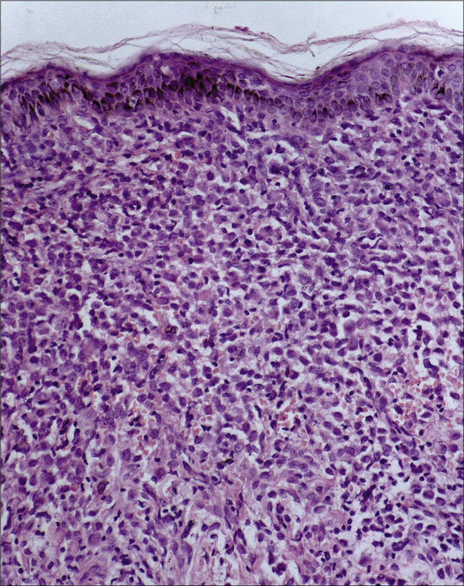 Infiltration by abnormal Langerhans cells (round to polygonal cells with oval nuclei having longitudinal grooves resembling coffee bean) in dermis. Stroma also shows the presence of eosinophils (hematoxylin and eosin, ×200)