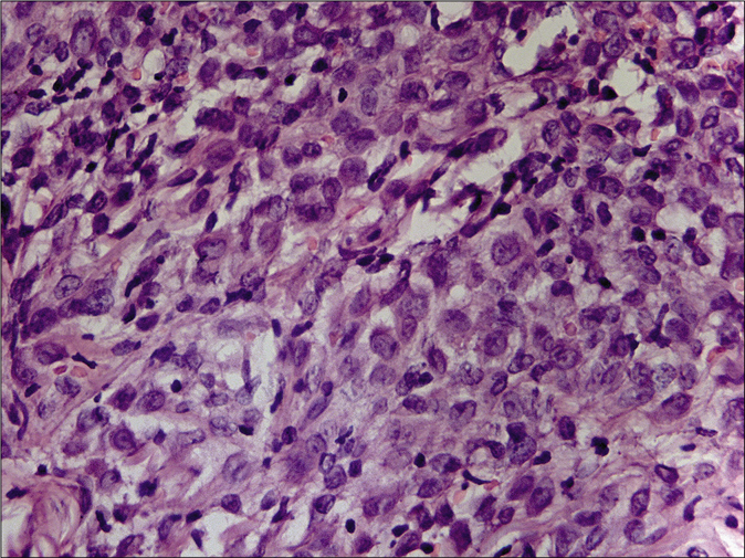 Langerhans cells showing prominent nuclear grooves with fine chromatin and small nucleoli (hematoxylin and eosin, ×1000)