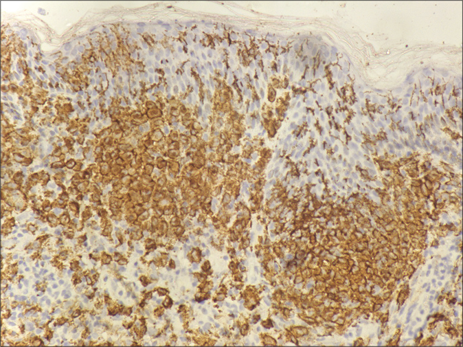 Langerhans cells in dermis showing immunoreactivity to CD1a (×400)