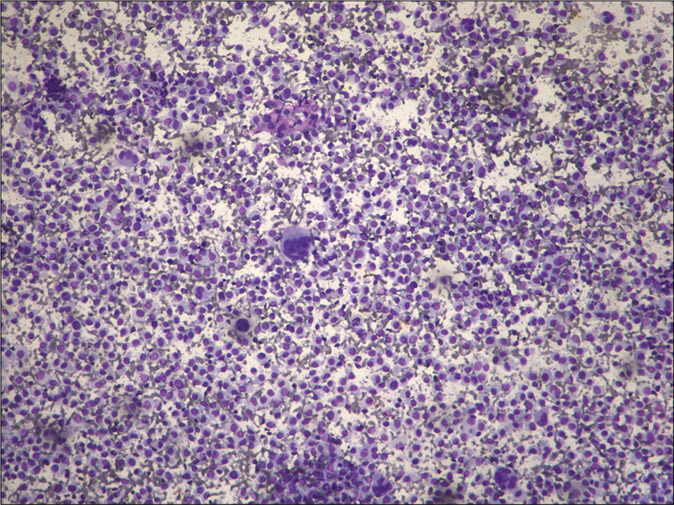 Smear showing lymphocytes with a fair number of abnormal histiocytes (Leishman, ×100)