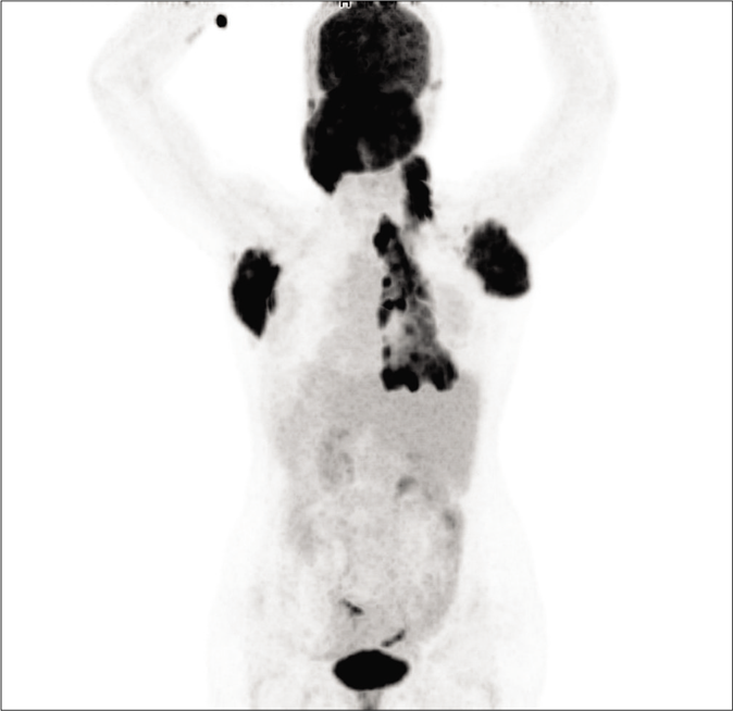 Positron emission tomography (PET) scan showed increased 18-fluorodeoxyglucose (FDG) uptake in nape of neck, axilla and right posterior thoracic wall including skeletal lesion in rib and vertebra.