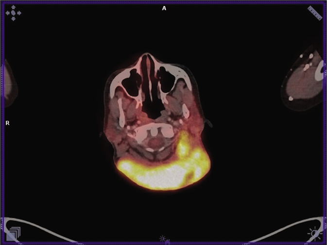 PET scan showing increased 18-FDG uptake in lesions on the nape of neck and left cervical lymph nodes