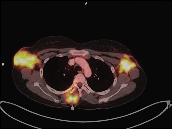 PET scan showing increased 18-FDG uptake in bilateral axillary lymph nodes and lesion in the left axilla involving lateral border of pectoralis major and left latissimus dorsi muscles