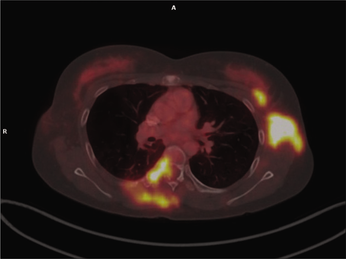 PET scan showing increased 18-FDG uptake in D6 vertebra and right 6th rib