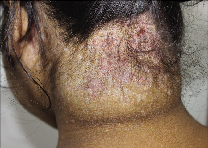 Resolving neck lesions after chemotherapy