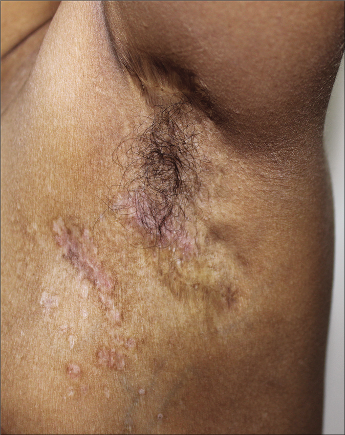 Resolving left axillary lesions after chemotherapy