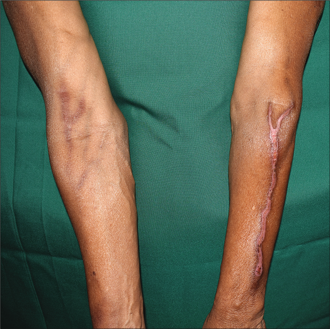 Linear hypopigmented plaque with superficial ulcers along the course of vein on left forearm (chemotherapy administered through a vein on contralateral right cubital fossa). Note the supraventine hyperpigmentation on the right cubital fossa, probably representing postinflammatory sequelae of an earlier chemotherapy recall reaction