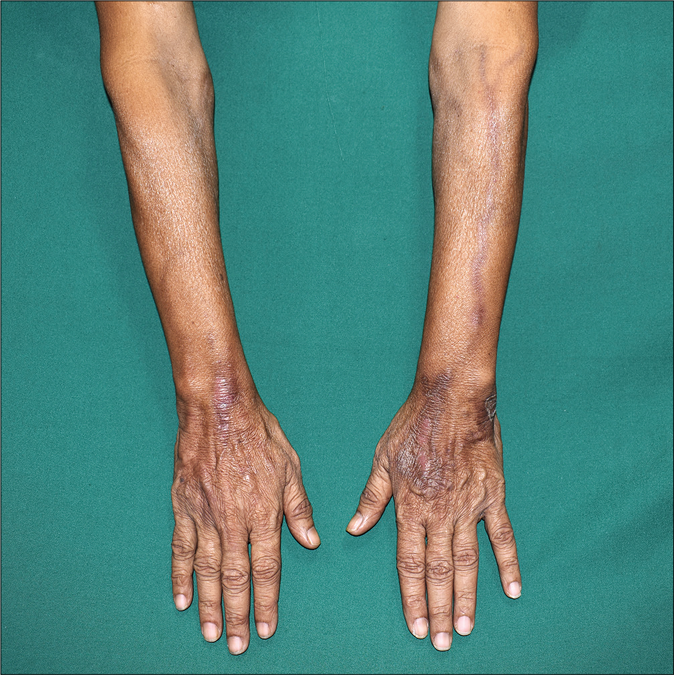 Bilateral dorsa of the hands showing dusky erythema and scaling over the veins through which the patient received his previous chemotherapy cycle. Note the previous recall reaction on the left forearm has subsided with hyperpigmentation