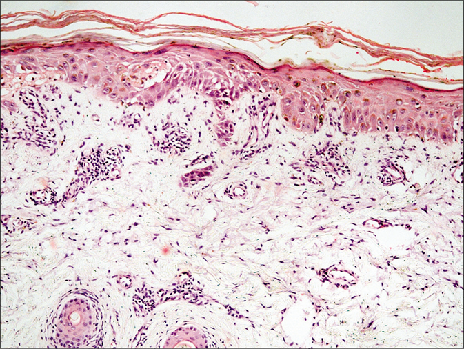 Skin biopsy showed focal parakeratosis, mild spongiosis and a few necrotic keratinocytes in the epidermis (H and E, ×100)