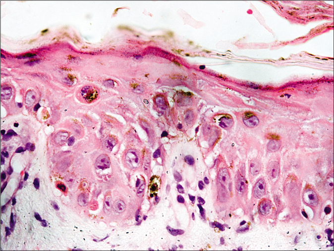 Higher magnification showing mild spongiosis, necrotic keratinocytes and focal vacuolar basal keratinocyte damage (H and E, ×400)