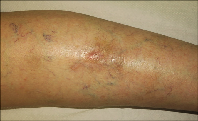 Clinical course. Complete healing of the wound 3 months after bevacizumab discontinuation