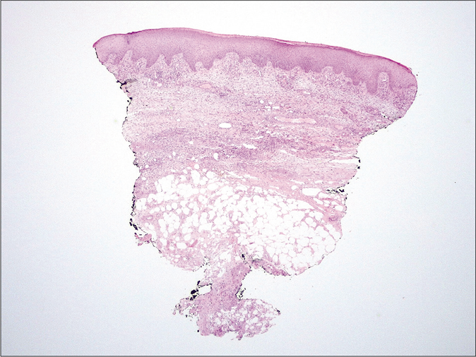 Histology. Predominantly septal dermato-panniculitis with associated signs of capillary thrombotic vasculopathy with no evidence of vasculitis (H and E, ×10)