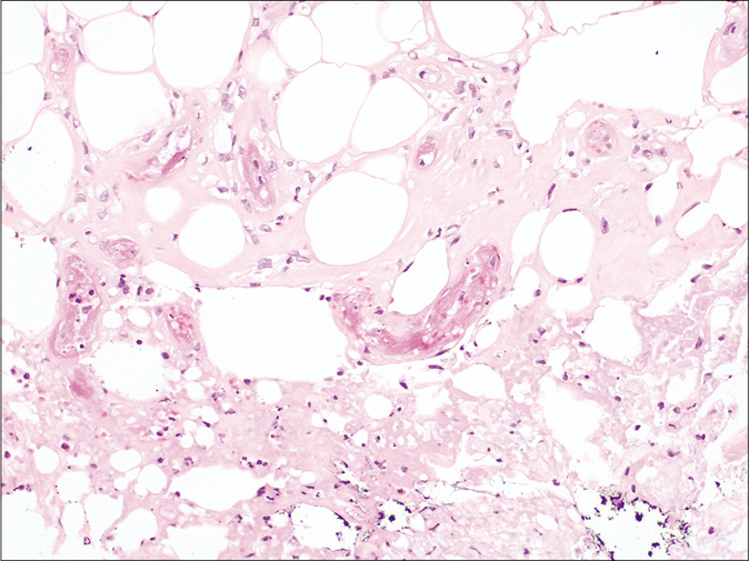 Histology. Fibrin thrombus inside the capillary vessels of the hypodermis without any signs of vasculitis nor inflammation (H and E, ×200)