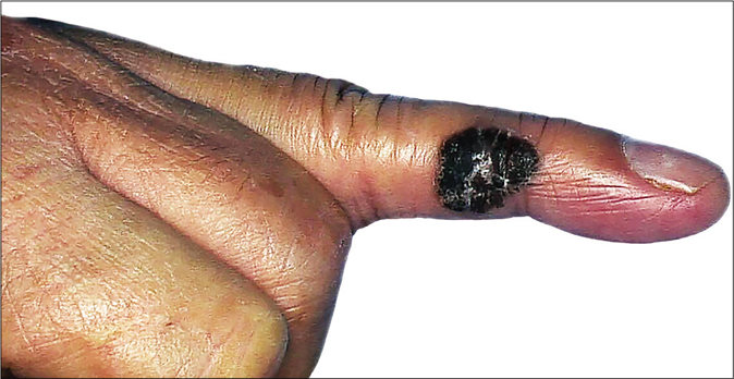 Elevated, asymmetric dark brown plaque on the left ring finger with scaly surface, measuring 18 mm × 14 mm in size