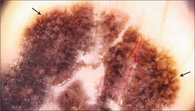 Atypical pigment network (black arrows), linear ulceration (※)