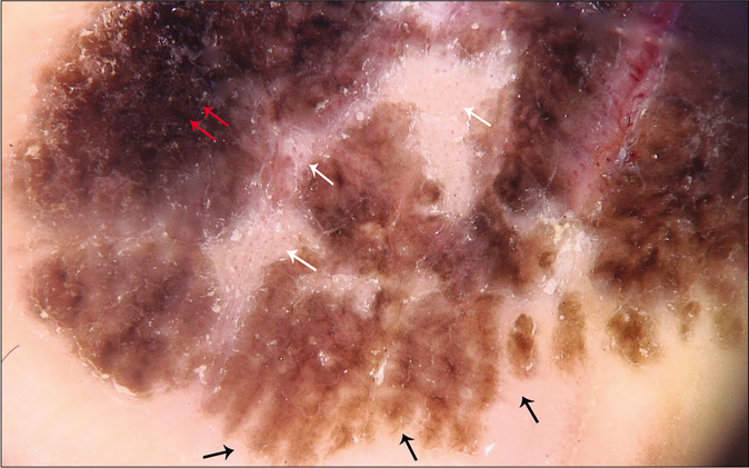 Parallel ridge pattern (black arrows), dotted vessels on regression like areas (white arrows), and irregular blotch (red arrows). (non-polarized dermoscopy, ×20; Medicam 800, FotoFinder SystemsGmbh, Birbach, Germany)