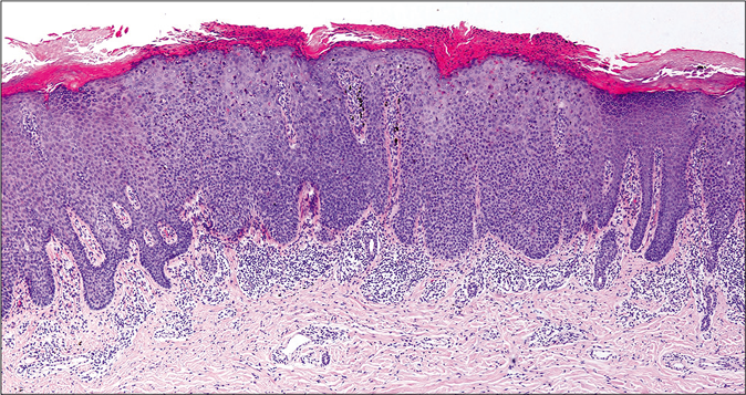 Hyperkeratosis, parakeratosis, acanthosis and irregular elongation of rete ridges without atypical cells in the upper dermis were found (H and E, ×40)