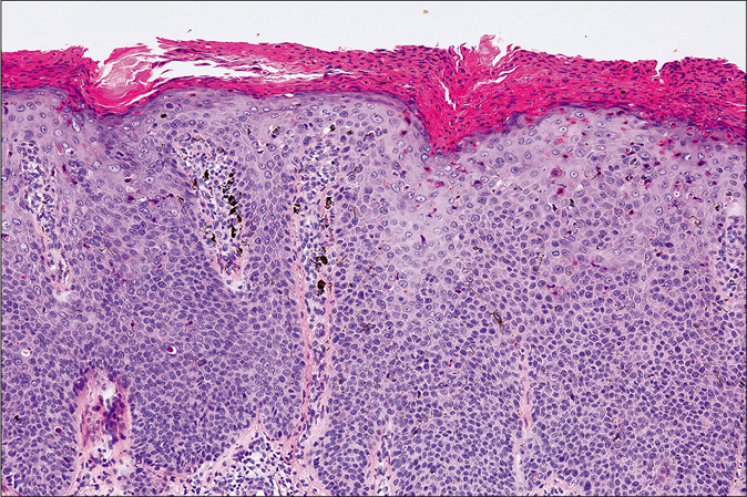 Disorganized atypical keratinocytes throughout epidermis with densely distributed melanin granules (H and E, ×100)