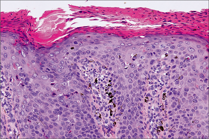 Atypical mitotic figures (white arrows) and individual keratinized cells in the epidermis (H and E, ×400)