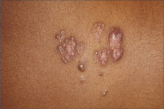 Multiple, discrete, skin-colored to translucent, firm papules on the mid-back with most having central umbilication and at places coalescing to form plaques.