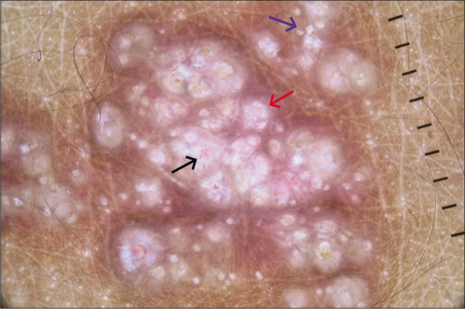 Dermoscopy (Dermlite, DL4, ×10) under polarized mode showing central crater surrounded by shiny white lines and an outer rim of brown structureless area (red arrow), white rosette (blue arrow) and dotted vessels (black arrow).