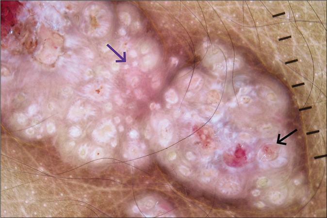 Dermoscopy (Dermlite, DL4, ×10) under polarized mode showing white rosette (blue arrow) and dotted vessels (black arrow).