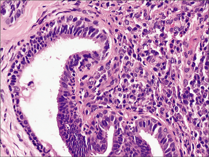 Histopathology showing hyperkeratosis, papillomatosis, dermal cystic invaginations along with dense inflammatory cells in the upper dermis and dilated apocrine ducts in the lower dermis (H and E, ×100).