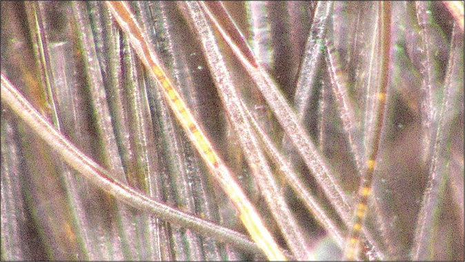 The tricoscopic image of the interrupted medulla finding of the hair shaft. (FotoFinder Medicam, polarized Light, ×700)