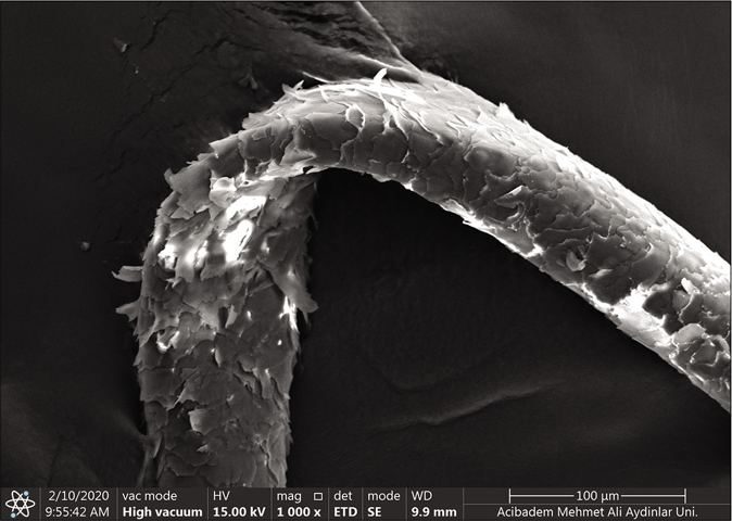 Scanning electron microscopic (Thermo Scientific Quattro, Czech Republic Vlastimila Pecha 1282/12) findings of the patient. Bending of the hair shaft on its long axis and the raised cuticle (×1000)