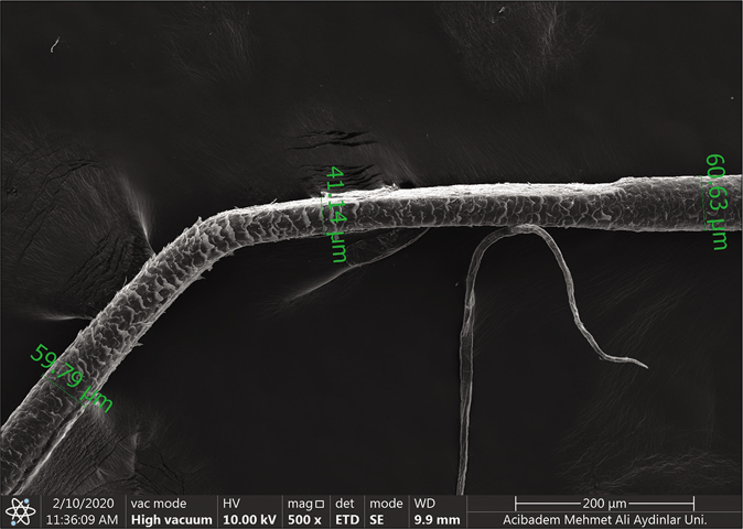 Scanning electron microscopic (Thermo Scientific Quattro, Czech Republic Vlastimila Pecha 1282/12) findings of the patient. Bending of the hair shaft, a sharp reduction in hair diameter (×500)