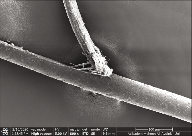 Scanning electron microscopic (Thermo Scientific Quattro, Czech Republic Vlastimila Pecha 1282/12) findings of the patient. The transverse splitting of the hair shaft (×800)