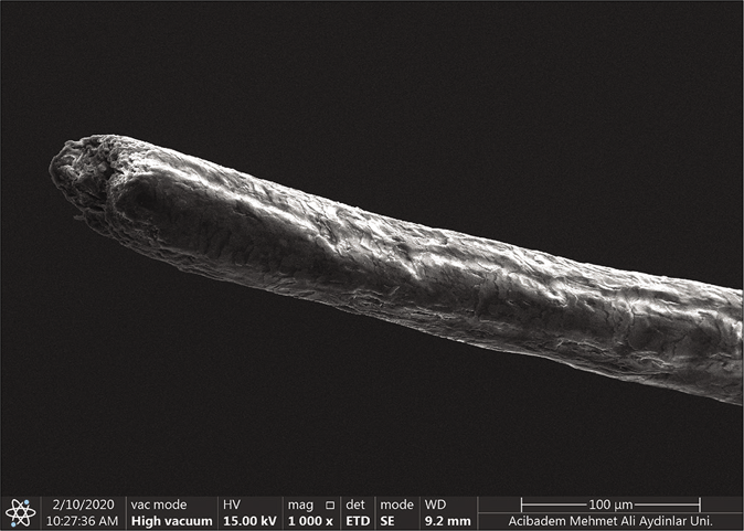 Scanning electron microscopic (Thermo Scientific Quattro, Czech Republic Vlastimila Pecha 1282/12) findings of the patient. Pili canaliculi, the canal formation on the hair shaft (×1200)