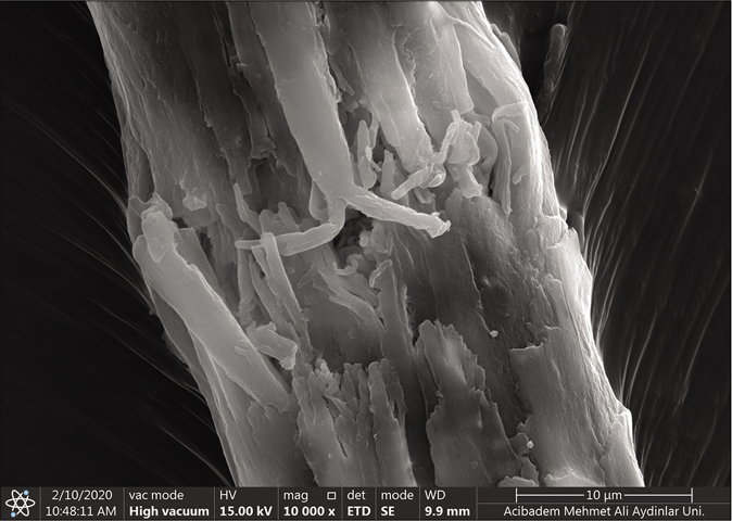 Scanning electron microscopic (Thermo Scientific Quattro, Czech Republic Vlastimila Pecha 1282/12) findings of the patient. Trichorrhexis nodosa (×10,000)