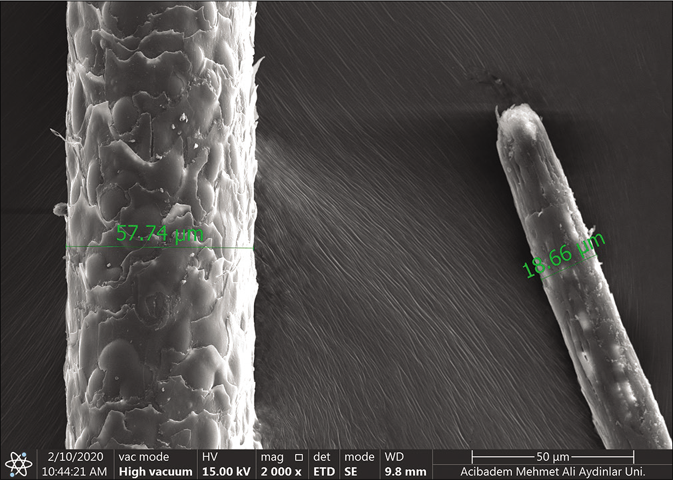 Scanning electron microscopic (Thermo Scientific Quattro, Czech Republic Vlastimila Pecha 1282/12) findings of the patient. Measurement of the proximal diameter (57.74 μm) and the distal diameter of the same hair shaft (18.66 μm) (×2000)