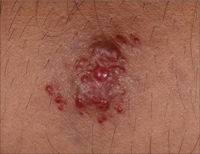 The patient presented with grouped, erythematous papules on his left forearm