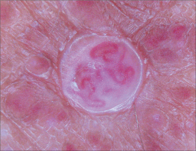 Dermoscopic examination revealed homogeneous erythematous background and telangiectatic serpentine vessels