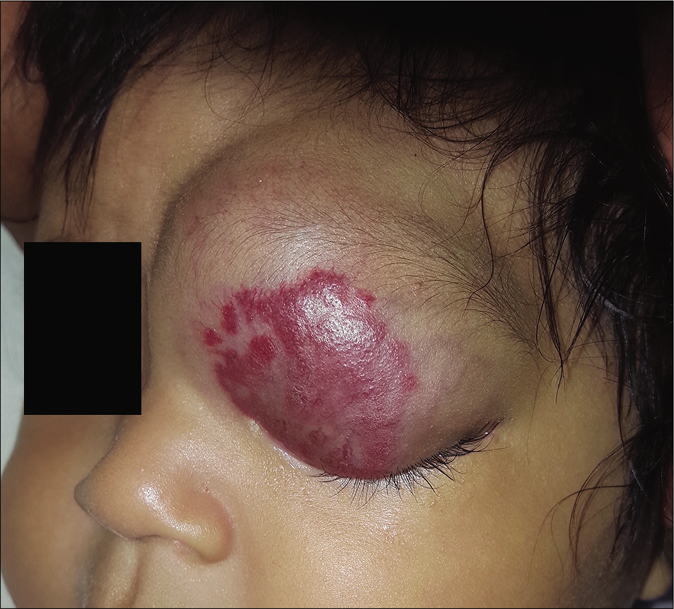 Patient 1, mixed hemangioma in the upper eyelid