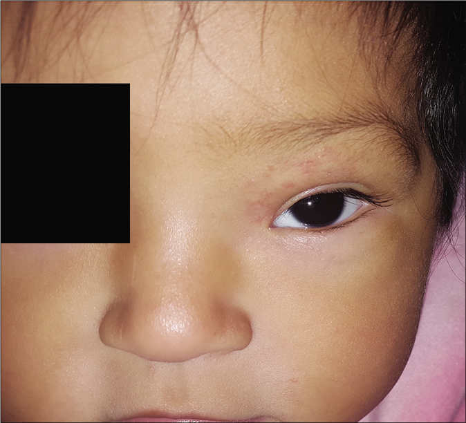 Residual fibro adipose tissue at 9 months of age