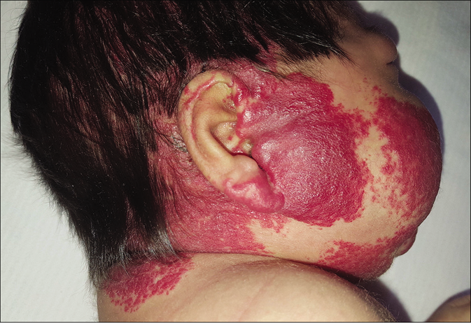 Patient 4, extensive segmental hemangioma